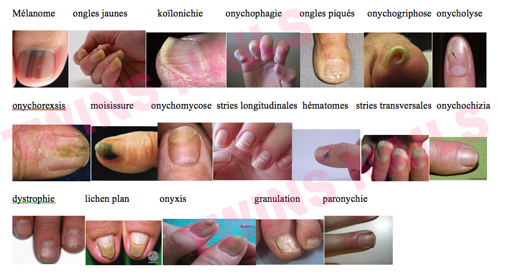 MALADIE-DES-ONLGES-FORMATION-TWINS-NAILS