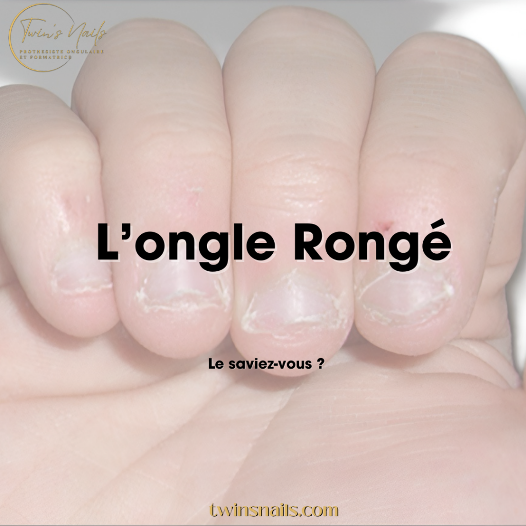 L'ONGLE RONGÉ