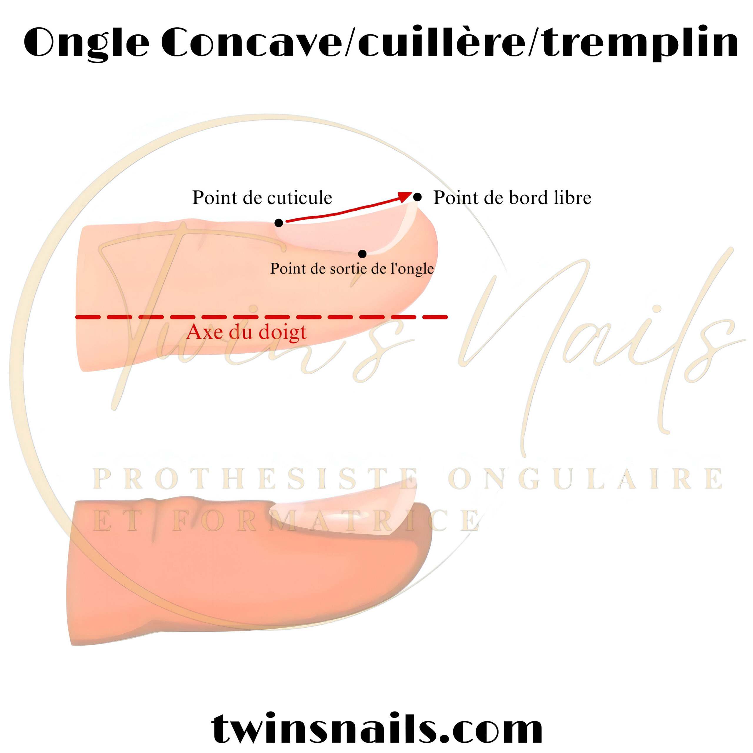 L'ONGLE CONCAVE