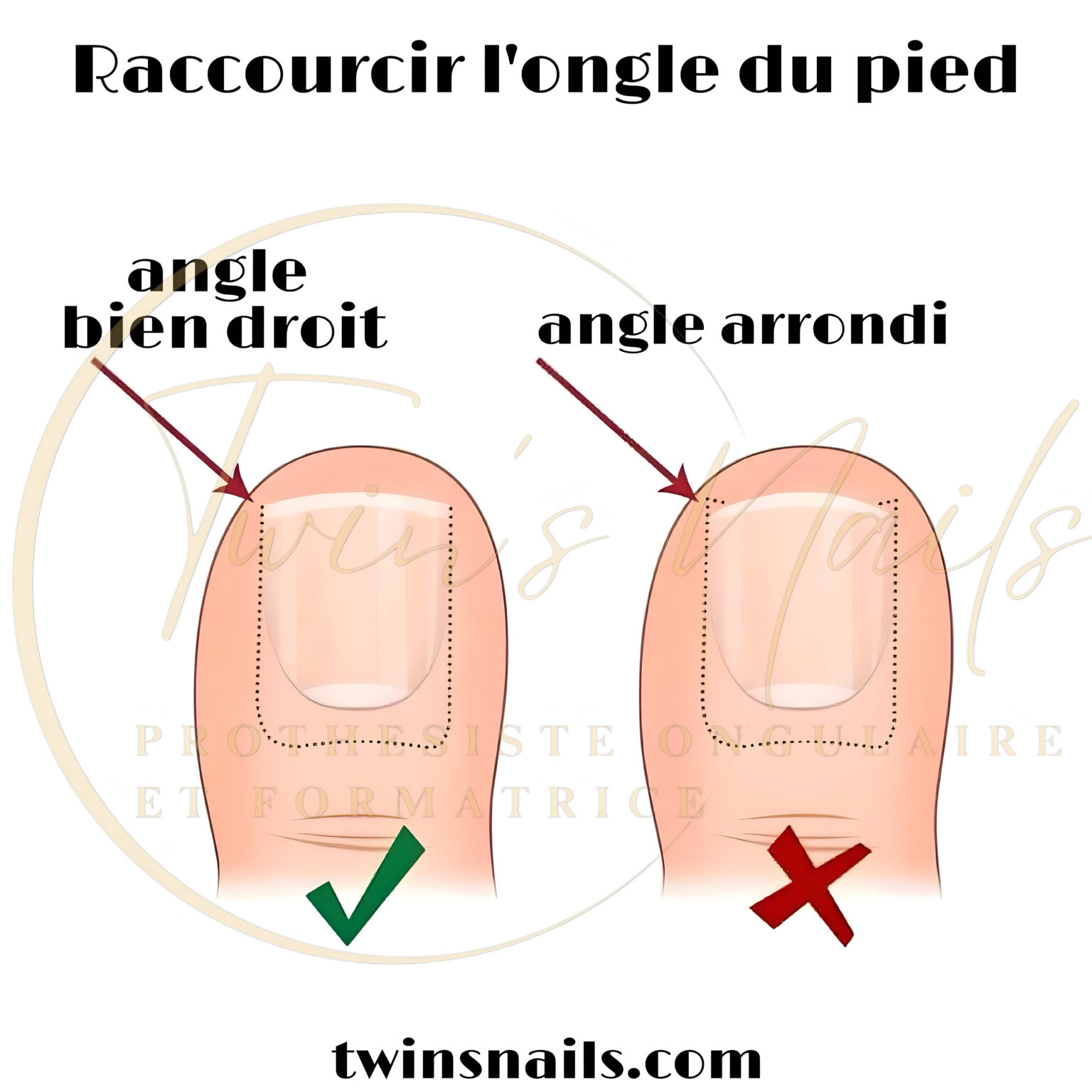 L'ONGLE DU PIED