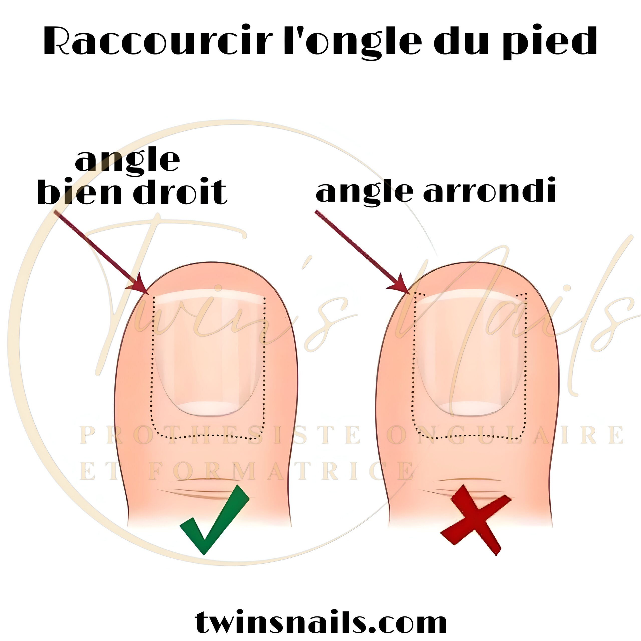 L'ONGLE DU PIED